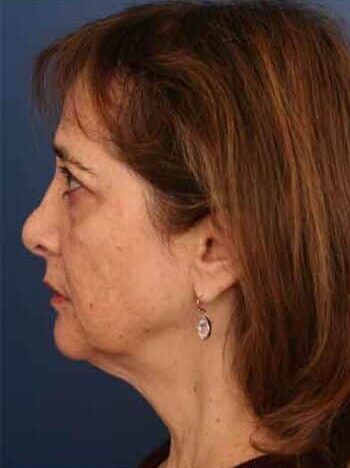 Before Image: Facelift - left-side