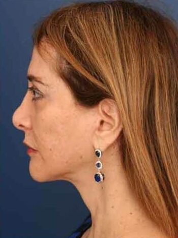 After Image: Facelift - left-side