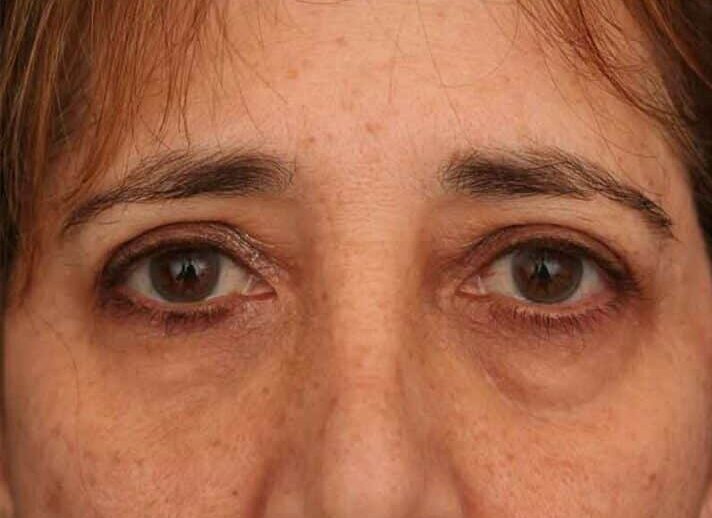 Before Image: Facelift - front