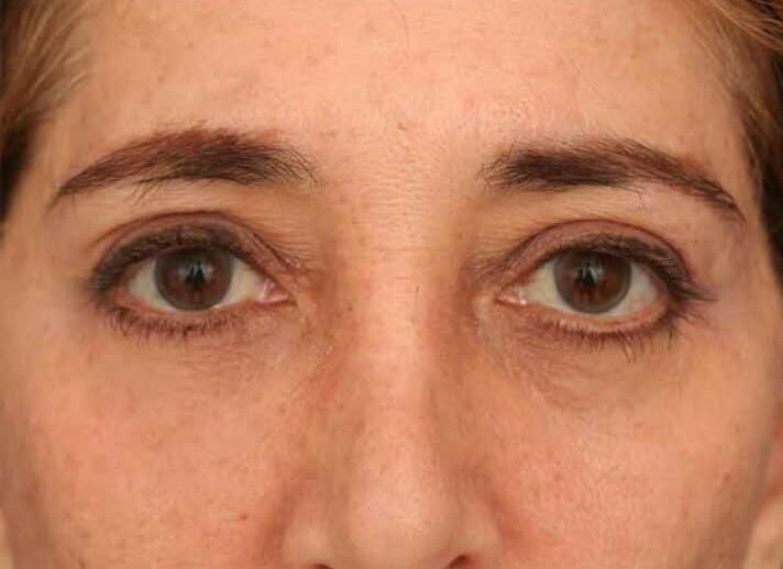 After Image: Facelift - front