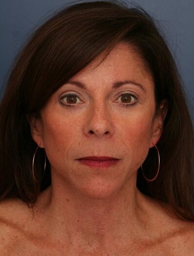 After Image: Facelift - front