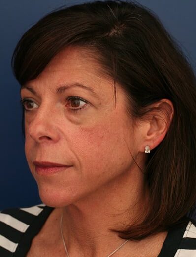 Before Image: Facelift - left-front-oblique