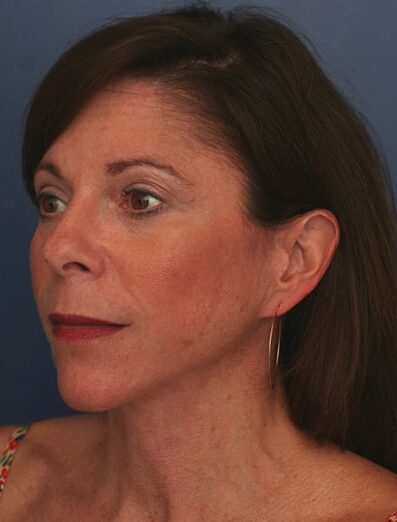 After Image: Facelift - left-front-oblique