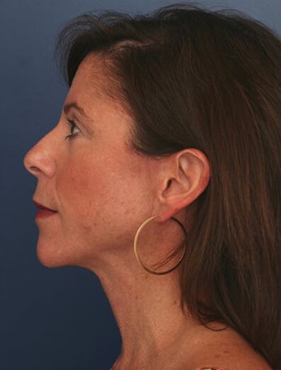 After Image: Facelift - left-side
