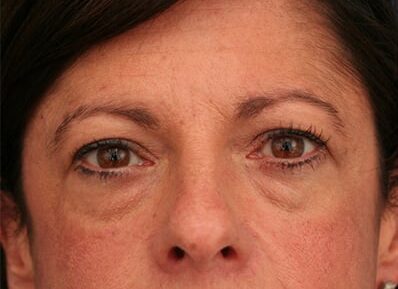 Before Image: Facelift - front