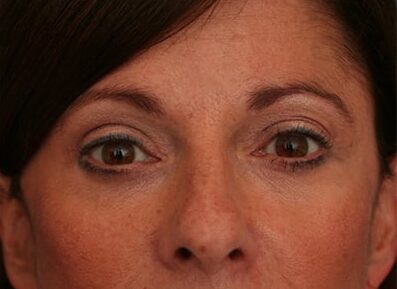 After Image: Facelift - front
