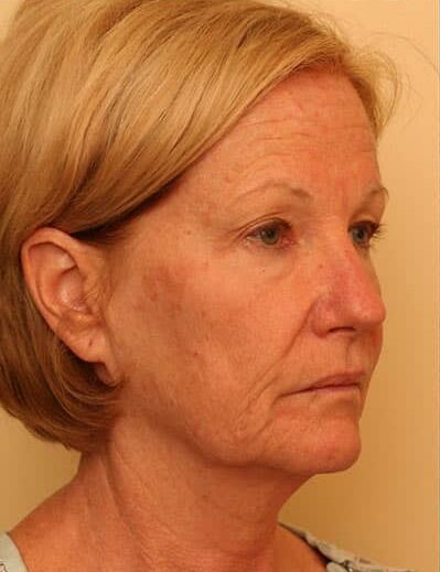 Before Image: Facelift - right-front-oblique