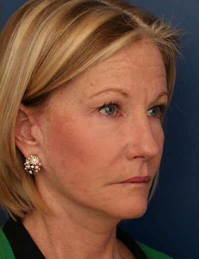 After Image: Facelift - right-front-oblique