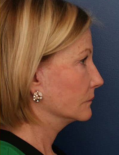 After Image: Facelift - right-side