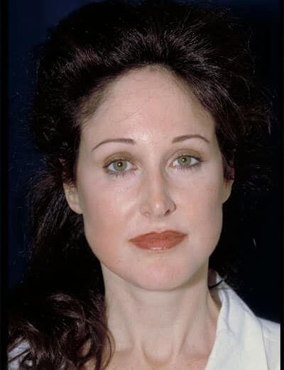 After Image: Facelift - front