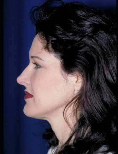 Before Image: Facelift - left-side