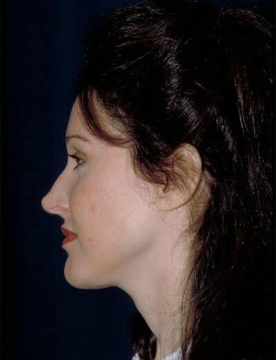 After Image: Facelift - left-side