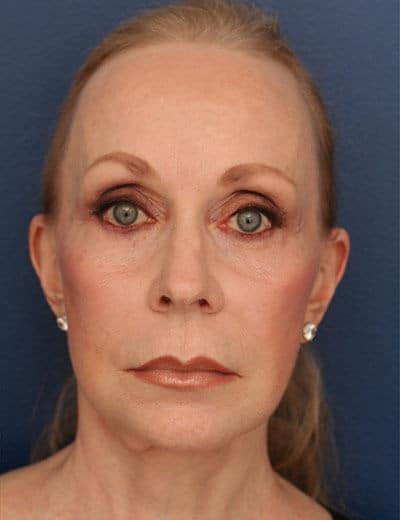 After Image: Facelift - front