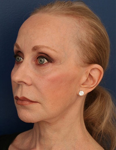 After Image: Facelift - left-front-oblique