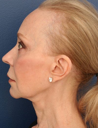 After Image: Facelift - left-side