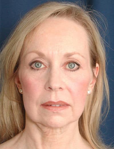 Before Image: Facelift - front