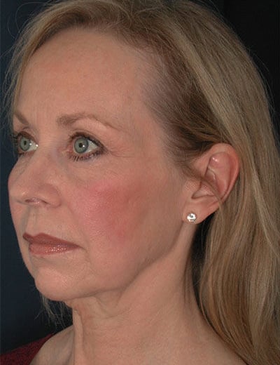 Before Image: Facelift - left-front-oblique