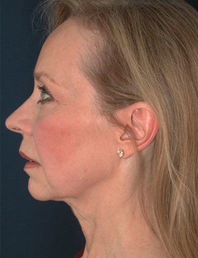 Before Image: Facelift - left-side