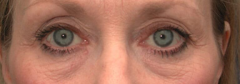 Before Image: Facelift - front