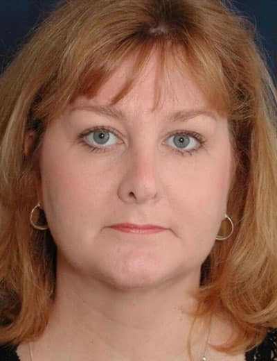 After Image: Fat Grafting - front