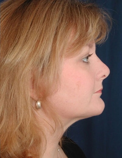 After Image: Fat Grafting - right-side