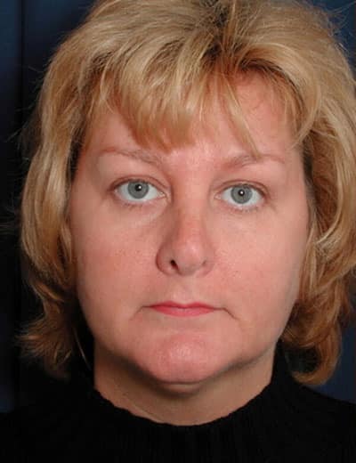 Before Image: Fat Grafting - front