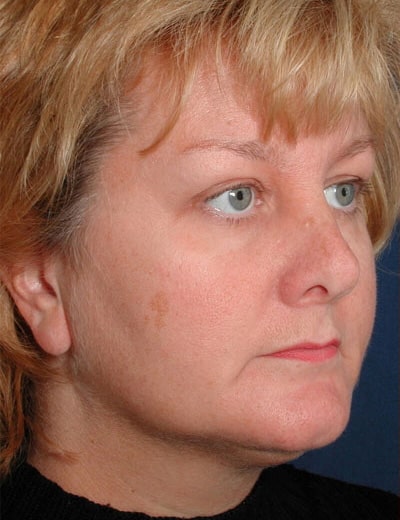 Before Image: Fat Grafting - right-front-oblique