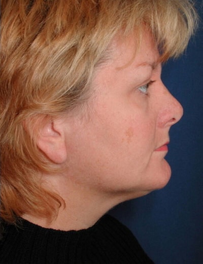Before Image: Fat Grafting - right-side