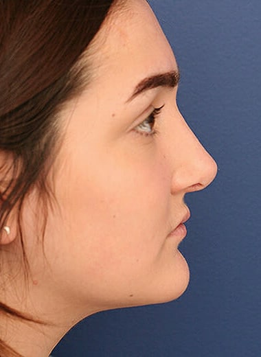 After Image: Fat Grafting - right-side