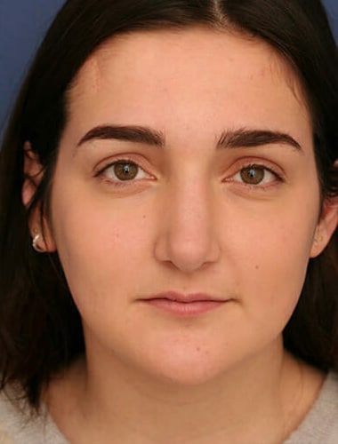 After Image: Fat Grafting - front