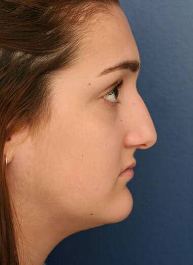 Before Image: Fat Grafting - right-side