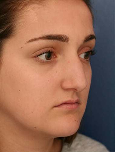 Before Image: Fat Grafting - right-front-oblique