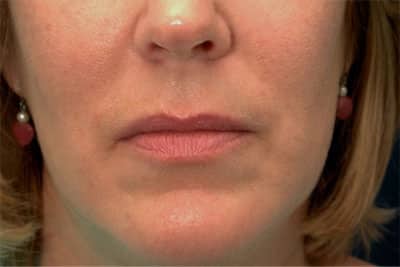 After Image: Fat Grafting - front