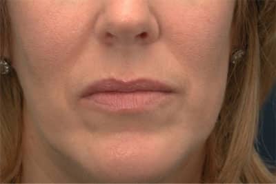 Before Image: Fat Grafting - front