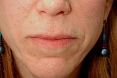 After Image: Fat Grafting - front