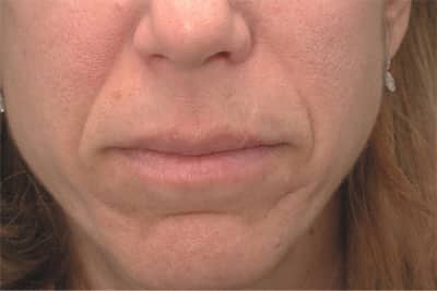 Before Image: Fat Grafting - front