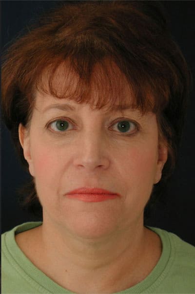 After Image: Fat Grafting - front