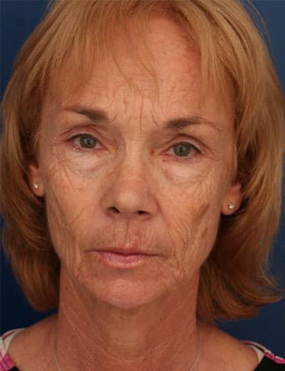 Before Image: Fat Grafting - front