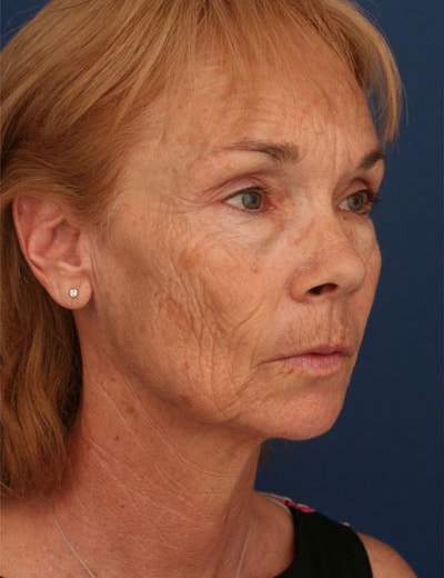 Before Image: Fat Grafting - right-front-oblique