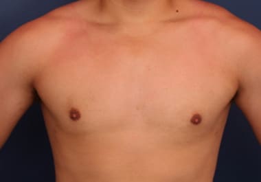 After Image: Gynecomastia - front