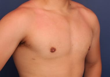 After Image: Gynecomastia - right-front-oblique