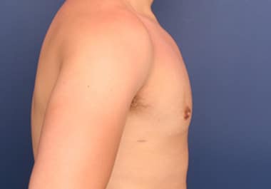 After Image: Gynecomastia - right-side