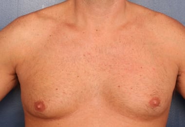 Before Image: Gynecomastia - front