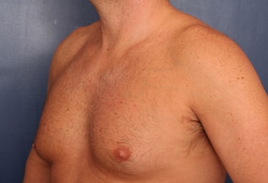 Before Image: Gynecomastia - left-front-oblique