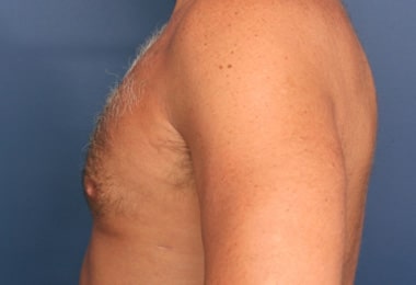 After Image: Gynecomastia - left-side