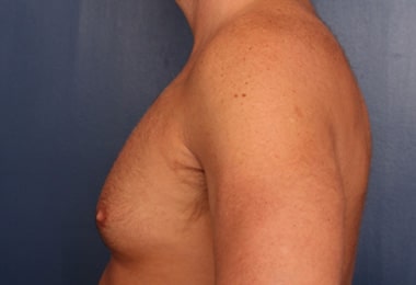 Before Image: Gynecomastia - left-side