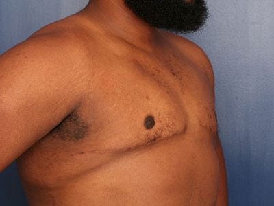 After Image: Gynecomastia - right-front-oblique