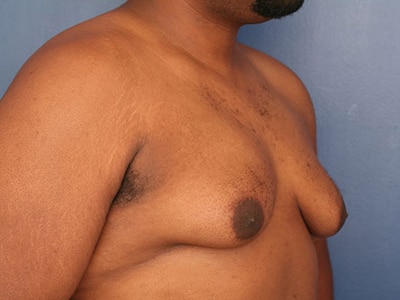Before Image: Gynecomastia - right-front-oblique