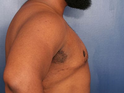 After Image: Gynecomastia - right-side