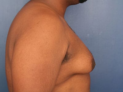 Before Image: Gynecomastia - right-side